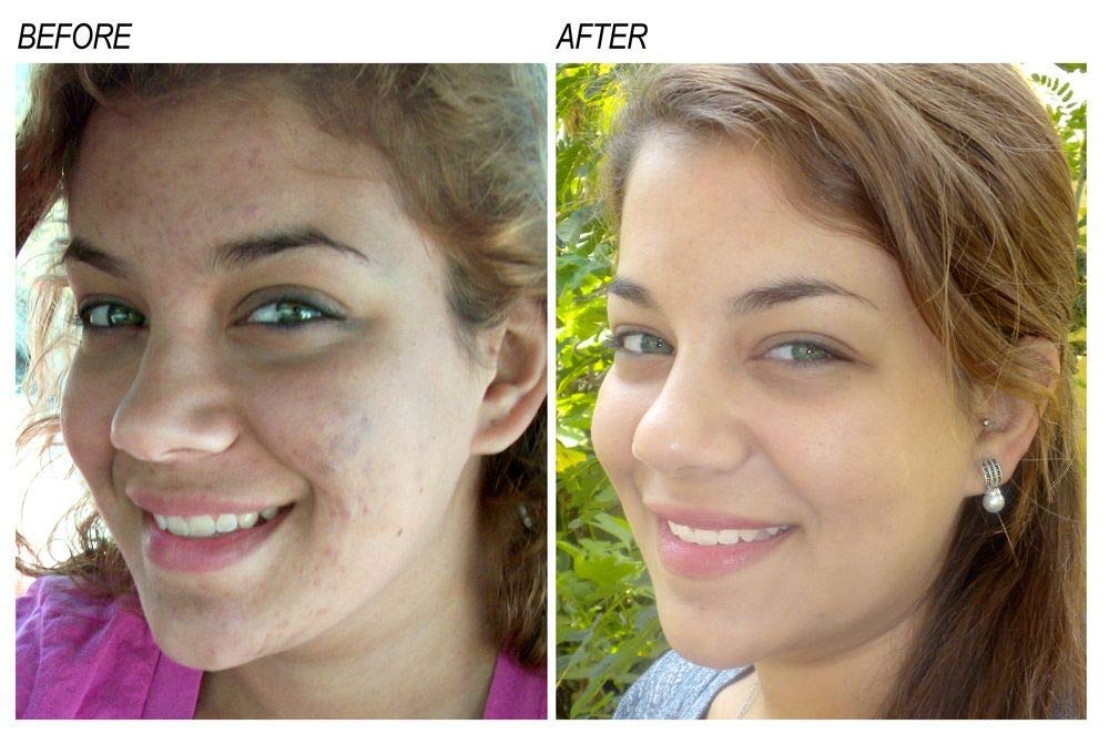 Neoprosone Vitamin C Serum for Face | 1 oz / 30 ml – Brightening Serum with Alpha Arbutin & Castor Oil