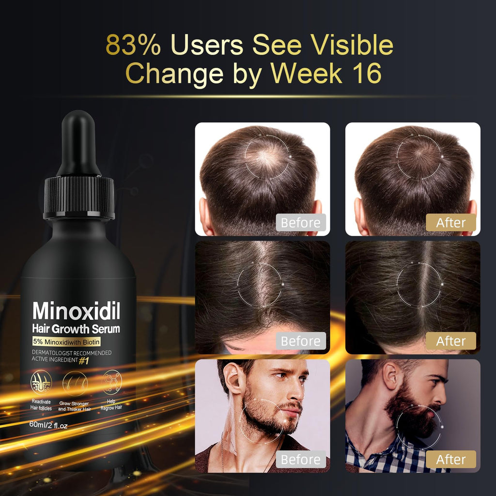 NETYIYUN 5% Minoxidil for Women and Men – Fuller, Thicker Hair (2 oz)