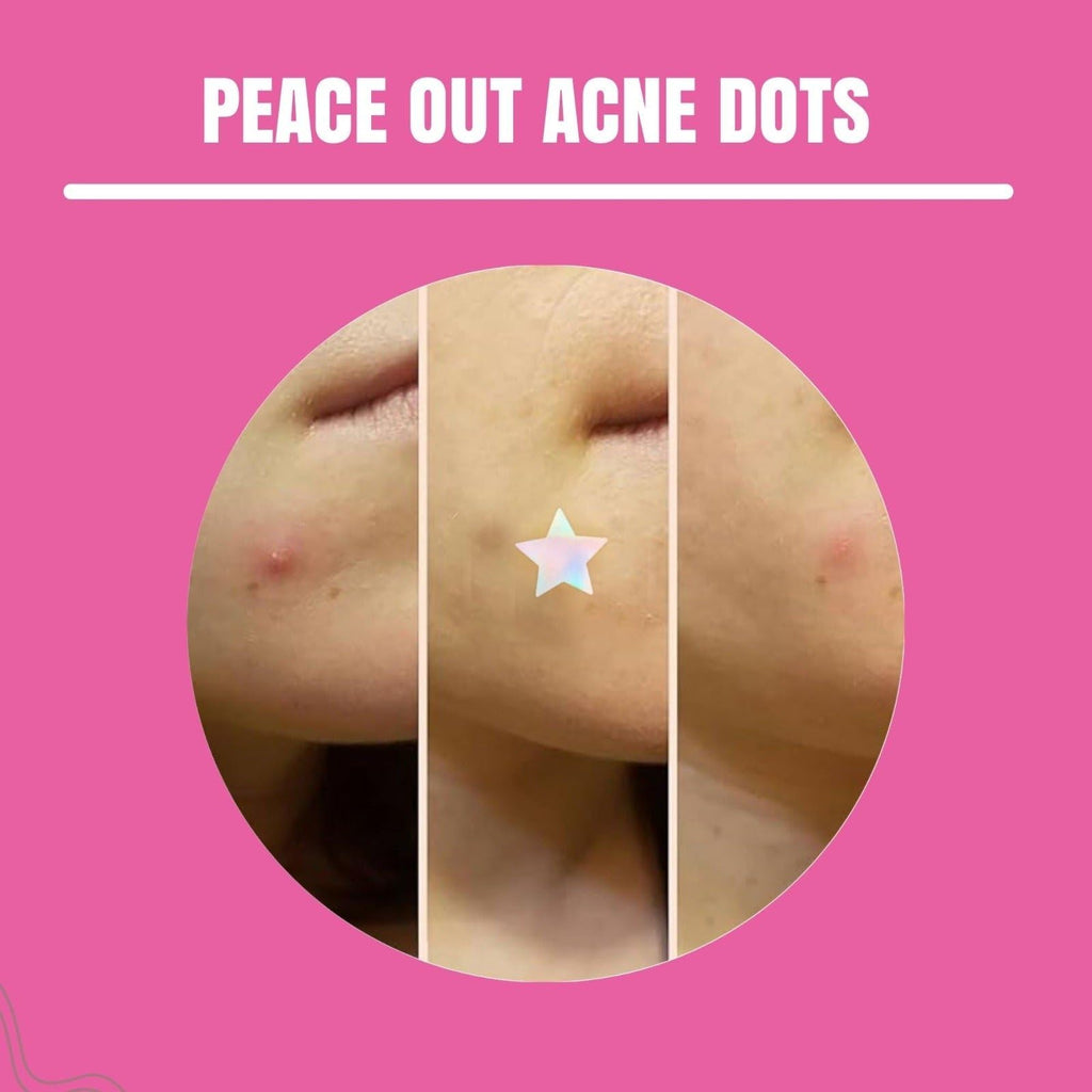 Neva Nude Pimple Patches for Face – Unicorn Wishes Holographic Star 56PK | Hydrocolloid Acne Patches