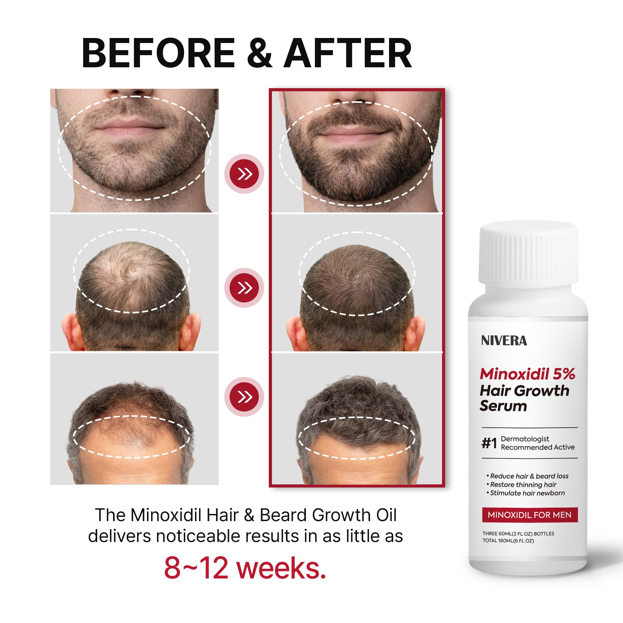 NIVELA 5% Minoxidil for Men — 3 x 60ml Extra Strength Hair & Beard Growth Kit