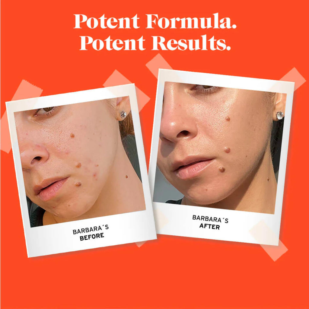 No Bad Stuff Acne Spot Treatment – 2% Salicylic Acid, Chamomile & Aloe Vera (0.5 oz)