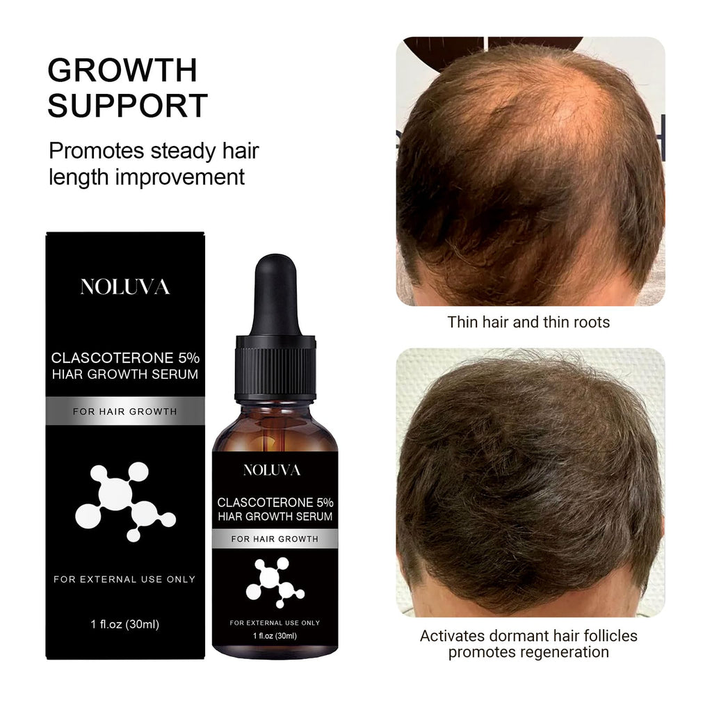 NOLUVA CLASCOTERONE 5% Hair Restoration Serum – Vitamin D, Minoxidil & Biotin (30ml)