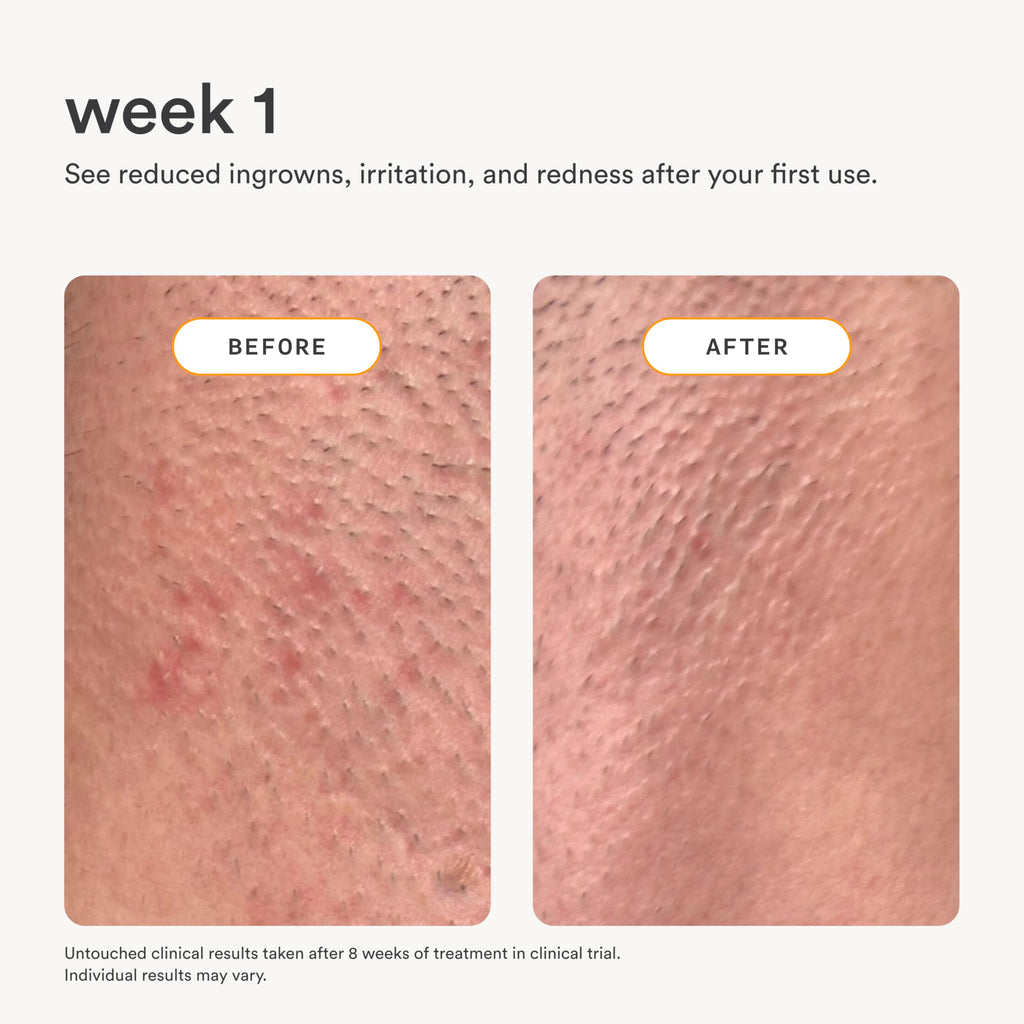 Nood NEW Serum — Slow Hair Regrowth, Shave Less, Ingrown Hair Care