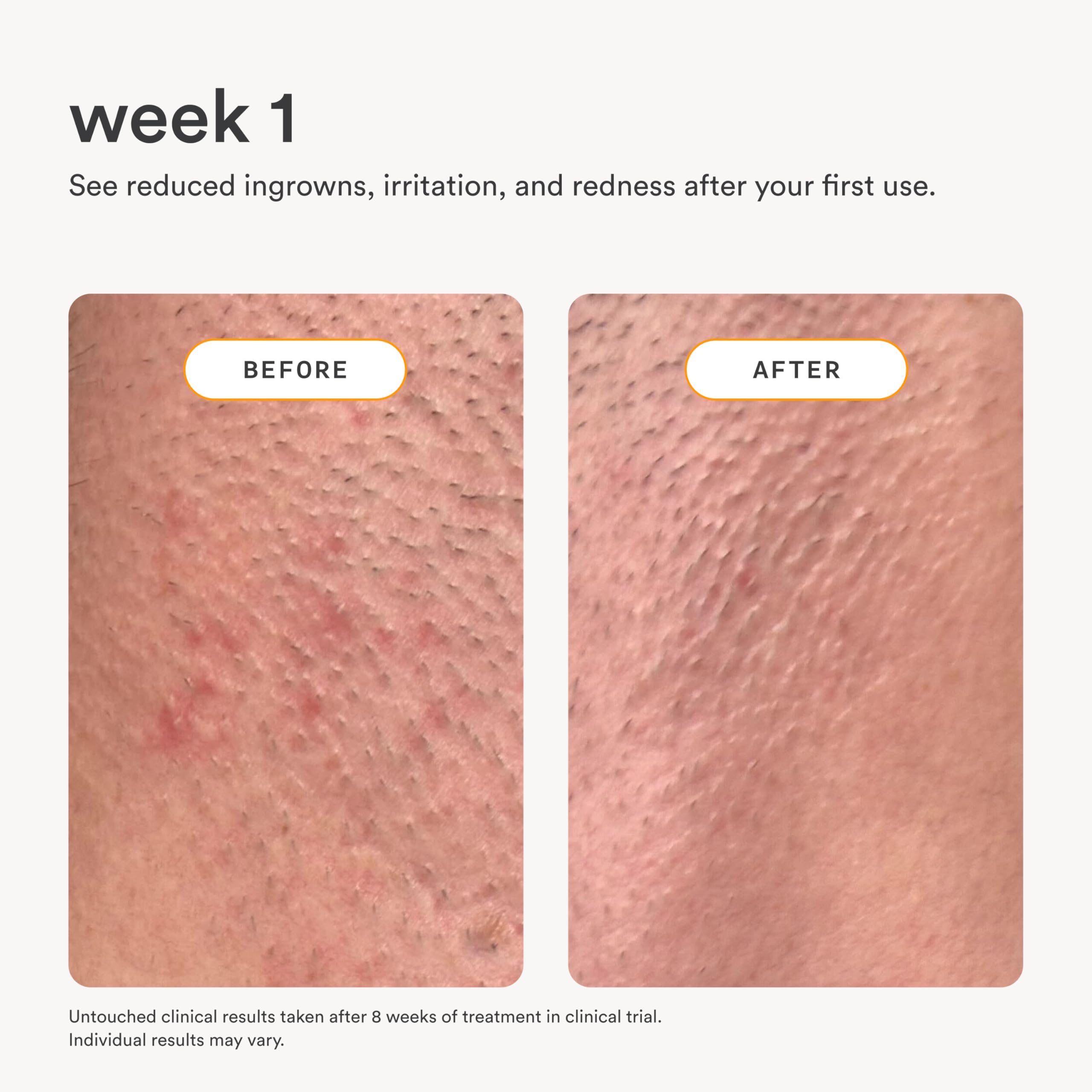 Nood NEW Serum — Slow Hair Regrowth, Shave Less, Ingrown Hair Care