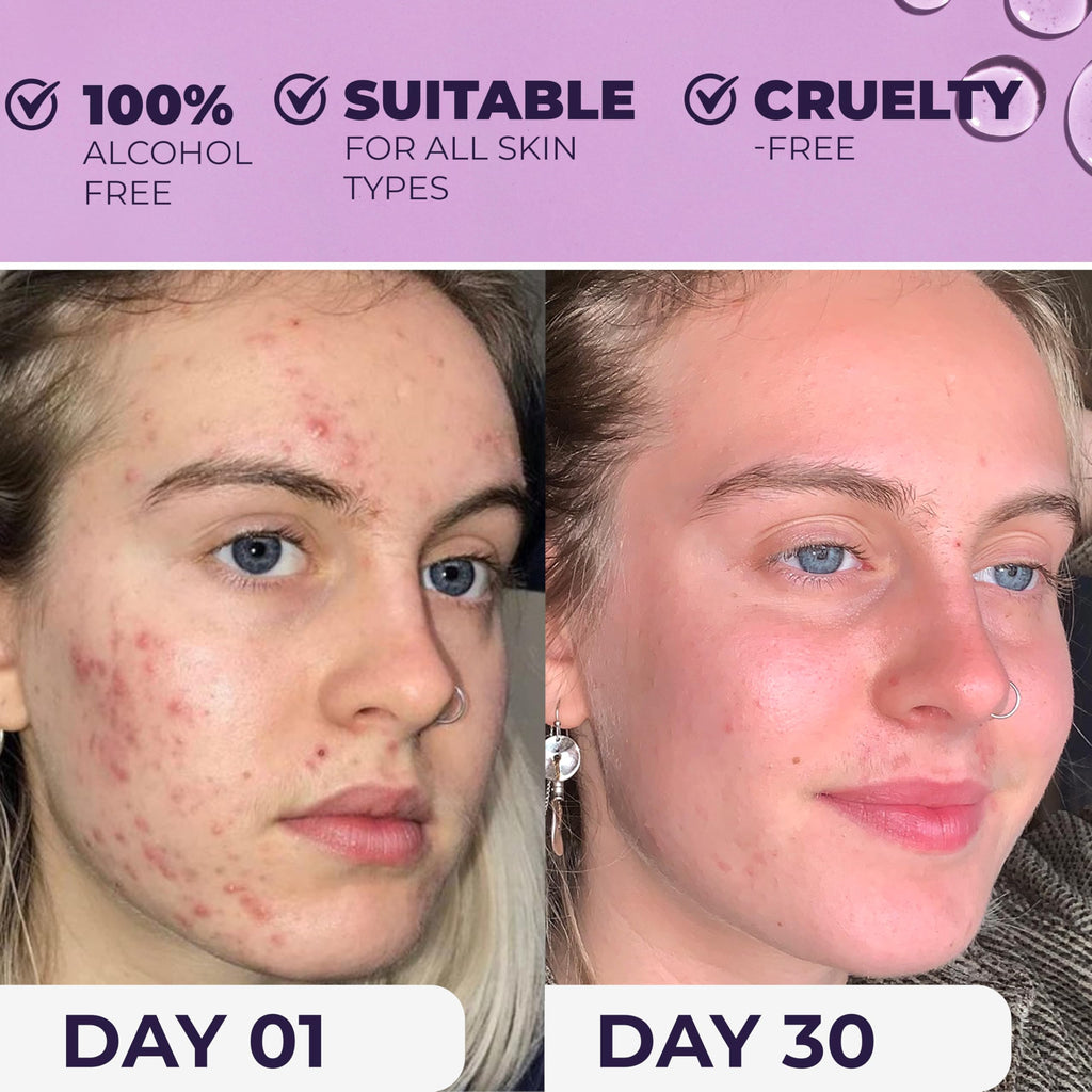 NXN Acne Facial Toner with Salicylic Acid, Witch Hazel & Probiotics | Alcohol-Free