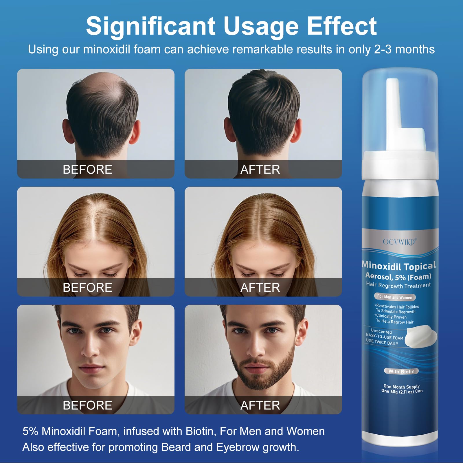 OCVWJKD 5% Minoxidil Foam with Biotin – Unisex Hair Growth Treatment, Unscented, 6-Month Supply
