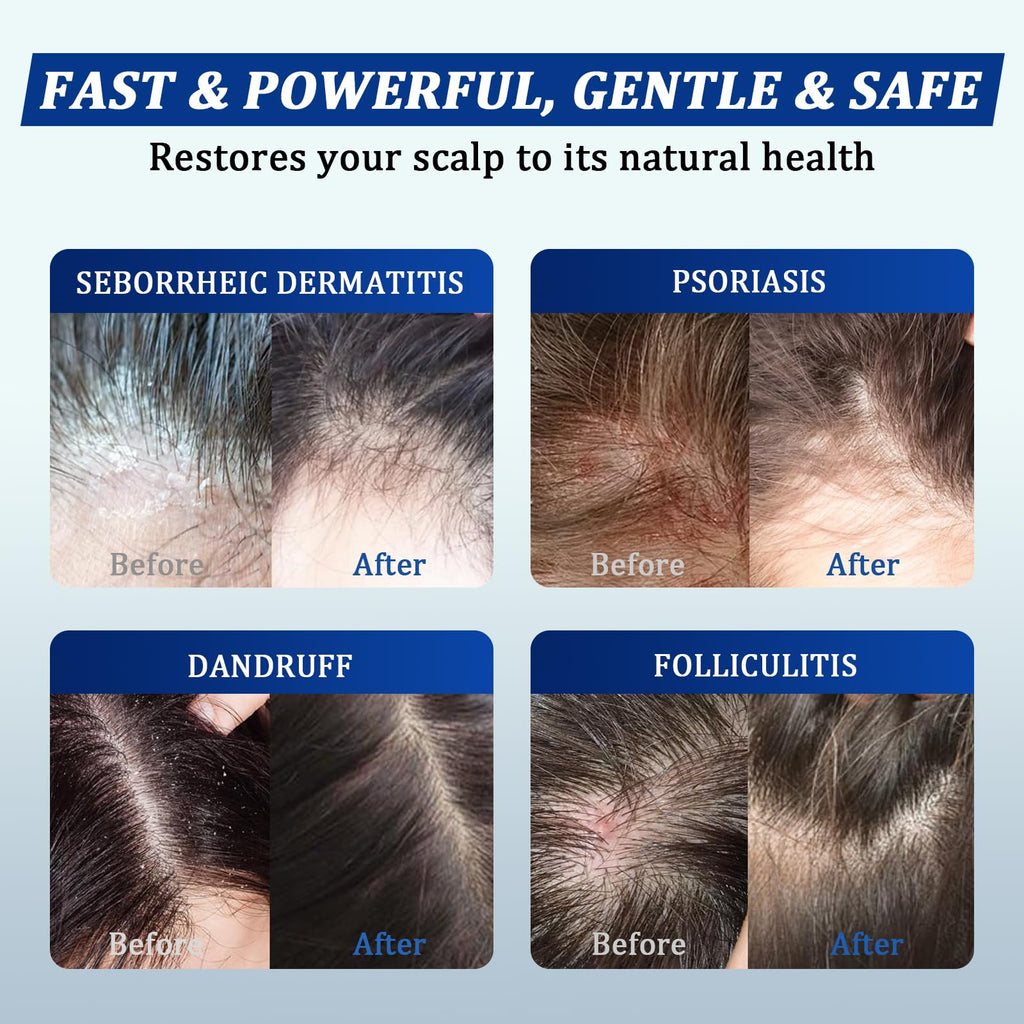 oely Antifungal Shampoo & Conditioner Set — Scalp Support for Folliculitis & Dermatitis