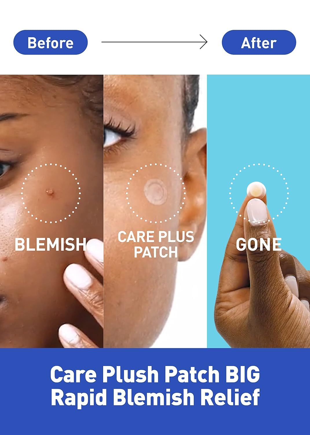 OLIVE YOUNG Care Plus Spot Patch | Hydrocolloid Acne Patches (Pack of 2, 60 Patches Total)