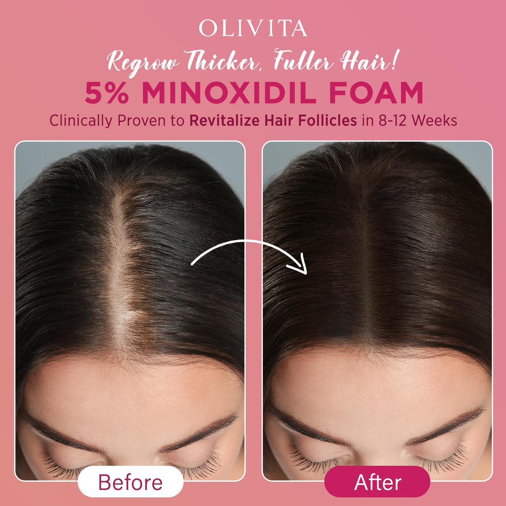 OLIVITA 5% Minoxidil Foam – Extra Strength Hair Regrowth for Women & Men, 2x60ml