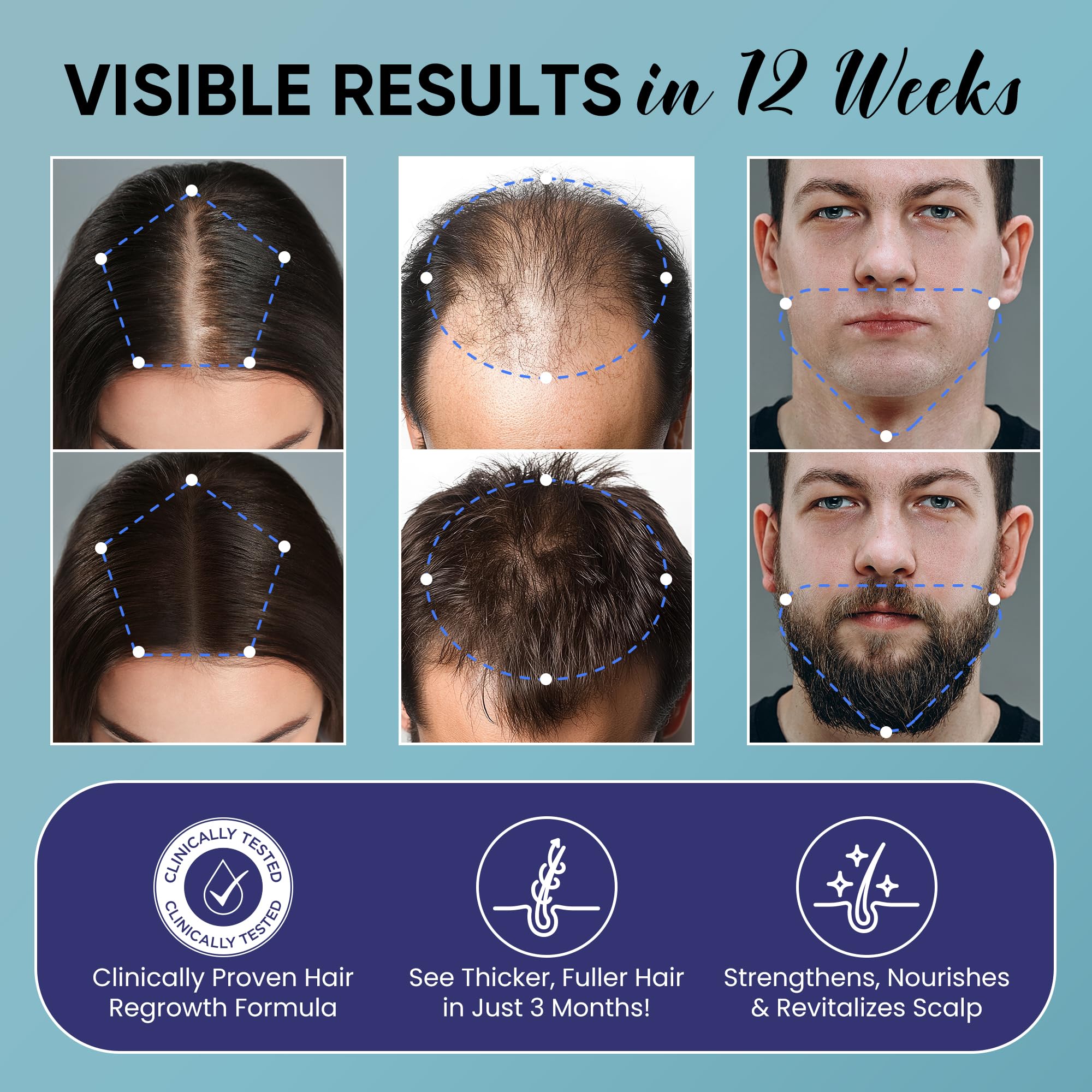 OLIVITA 5% Minoxidil Spray for Hair Growth – Biotin & Rosemary