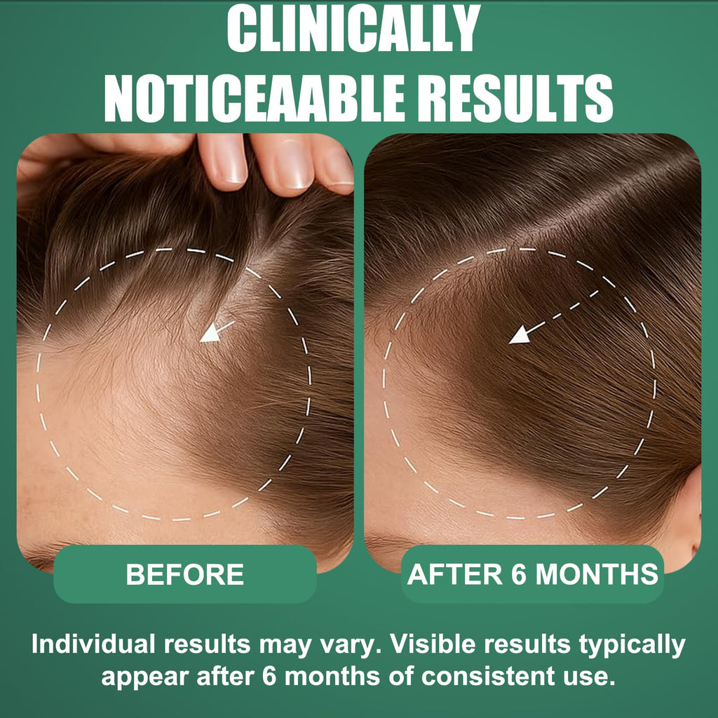 OURMUST 5% Minoxidil Hair Growth Spray for Men & Women – Biotin & Rosemary, 2 Bottles