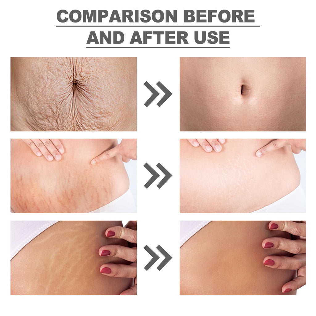 OWILIWO Silicone Belly Patches – Reusable Patch for Stretch Marks & Wrinkles (2pcs)