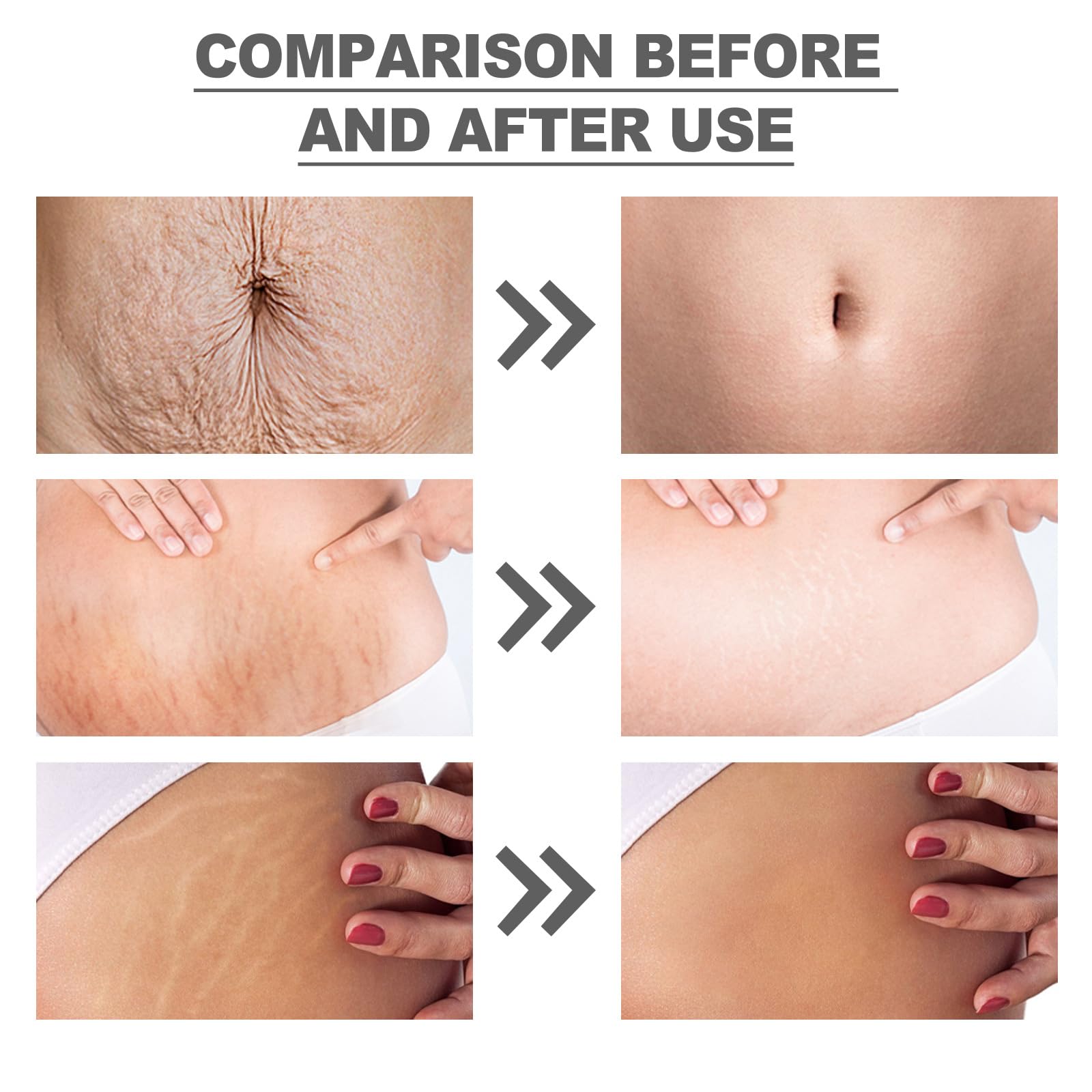 OWILIWO Silicone Belly Patches – Reusable Patch for Stretch Marks & Wrinkles (2pcs)