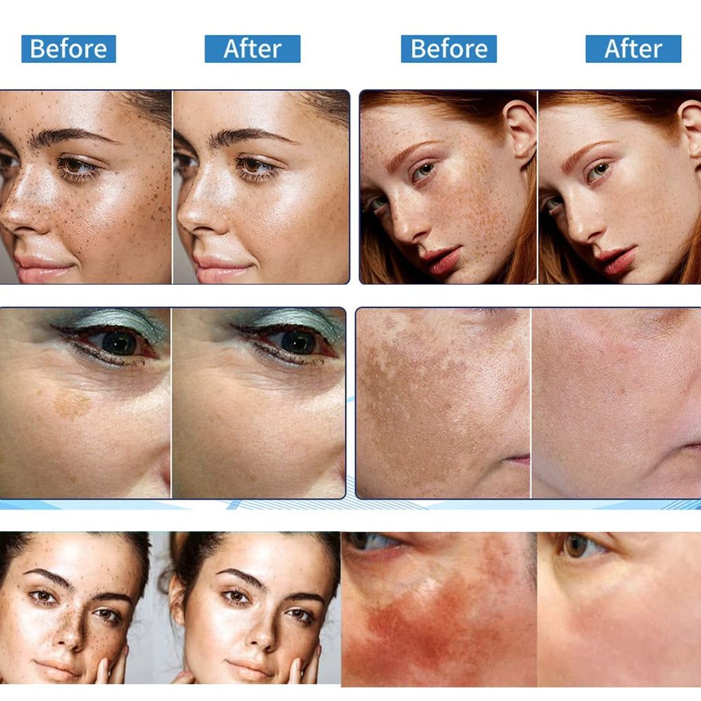 Paradise Emerald Dark Spot Remover for Face – Hyperpigmentation & Sun Spot Treatment for All Skin Types