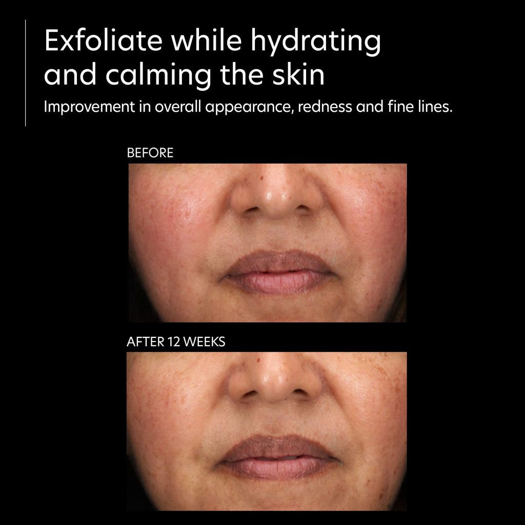 PCA SKIN Resurfacing Serum - Gentle Exfoliating Facial Corrective with Lactic & Glycolic Acid (1 fl oz)