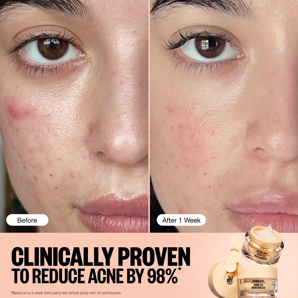 PEACE OUT Acne Gel Moisturizer for Oily Skin – 2% Salicylic Acid, Niacinamide & Ceramides (1.69 fl oz)