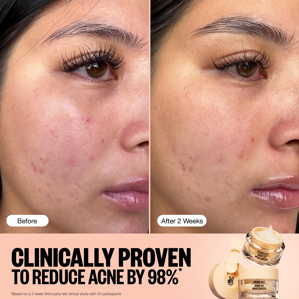 PEACE OUT Acne Gel Moisturizer for Oily Skin – 2% Salicylic Acid, Niacinamide & Ceramides (1.69 fl oz)
