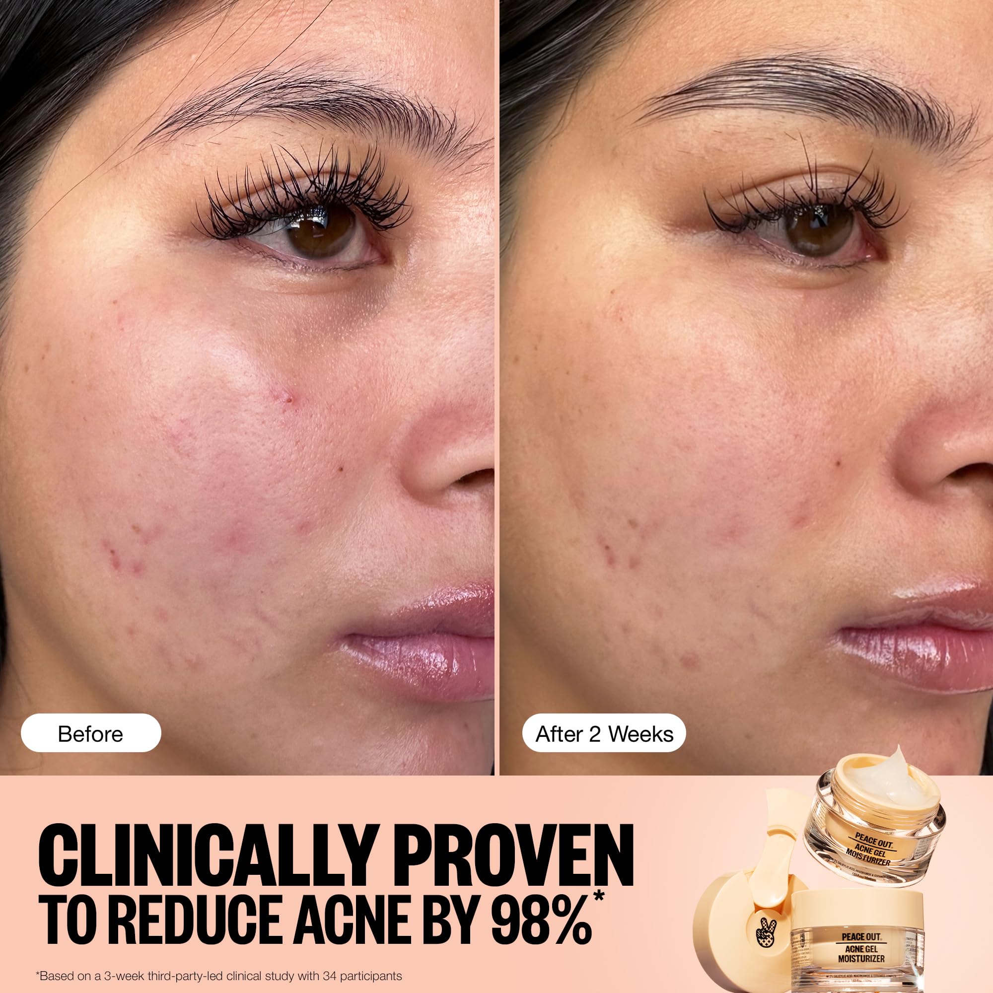 PEACE OUT Acne Gel Moisturizer for Oily Skin – 2% Salicylic Acid, Niacinamide & Ceramides (1.69 fl oz)