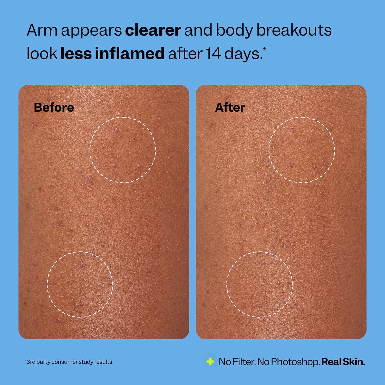 Peach Slices Body Breakout Patches (6 ct) – Overnight Hydrocolloid Patch with Cica, Hypoallergenic & Cruelty-Free