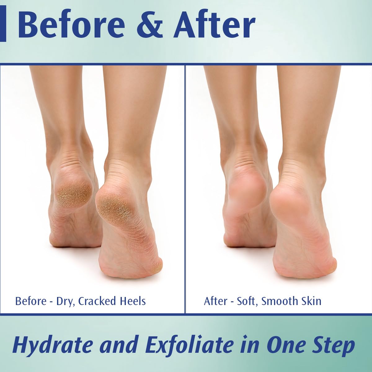 Pedifix Podiatrists' Choice 20% Urea Foot Cream – Extra Strength Callus Control, 4 oz
