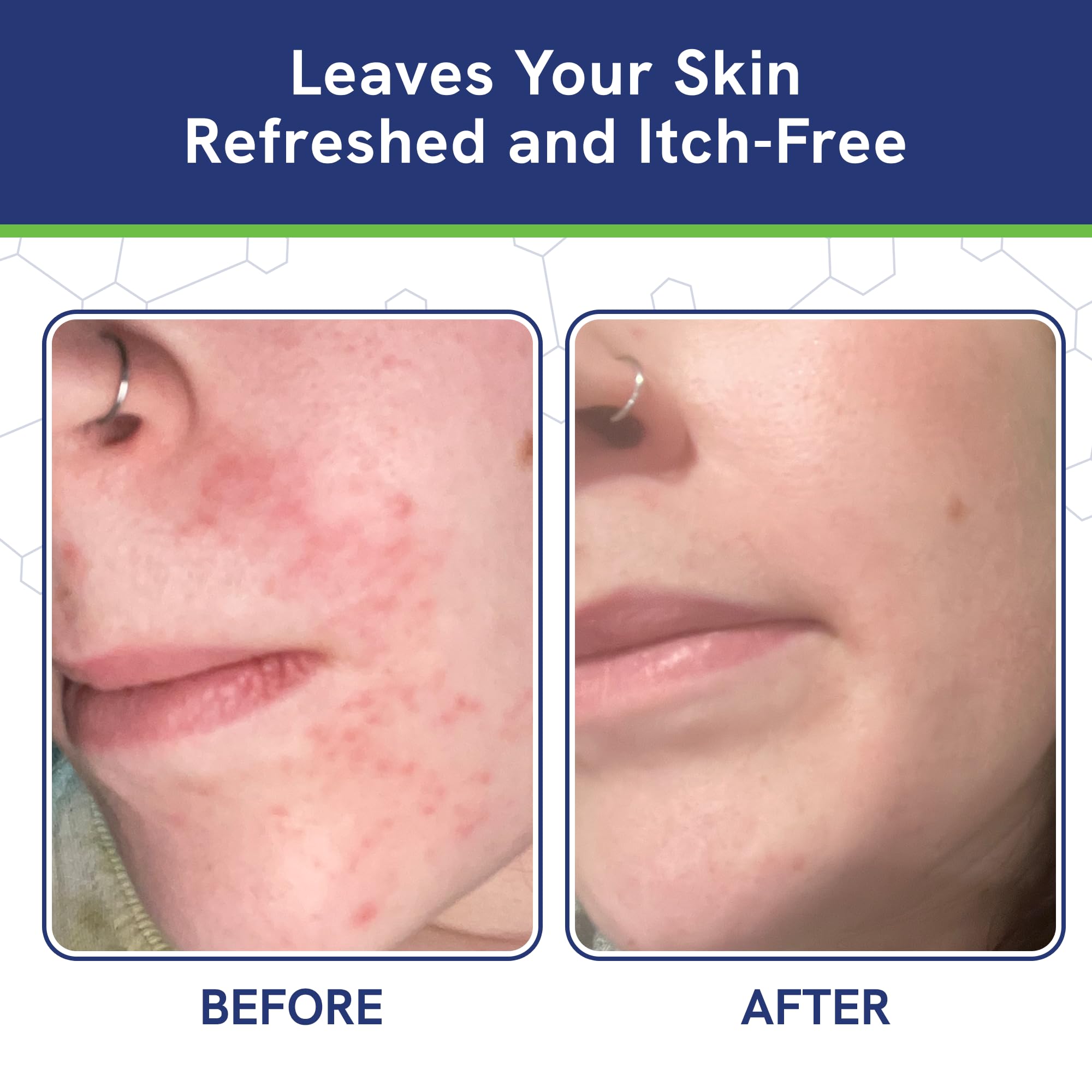 pHat 5.5 Itch Cream – Anti-Itch Relief & Hydration (4oz)