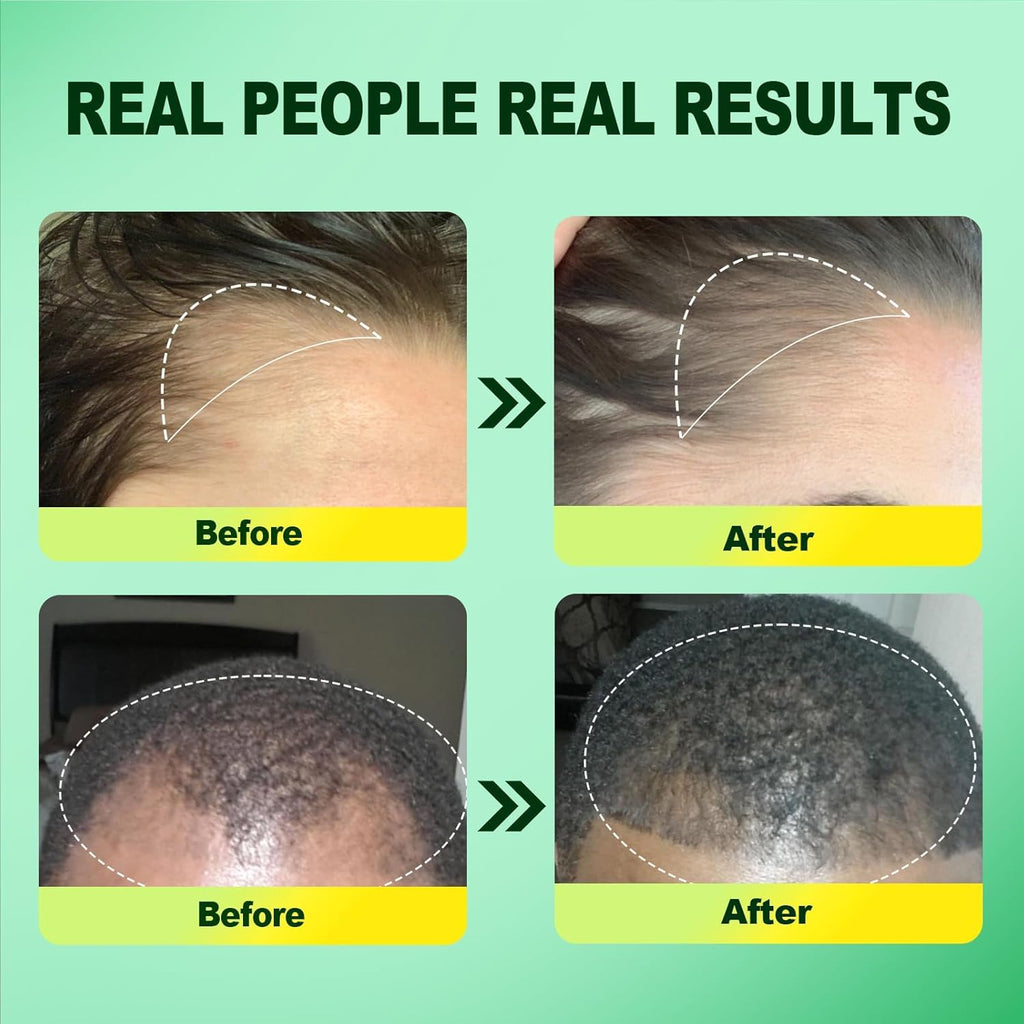 Pipuxi 5% Minoxidil Hair Growth Serum for Men & Women – Rosemary & Biotin