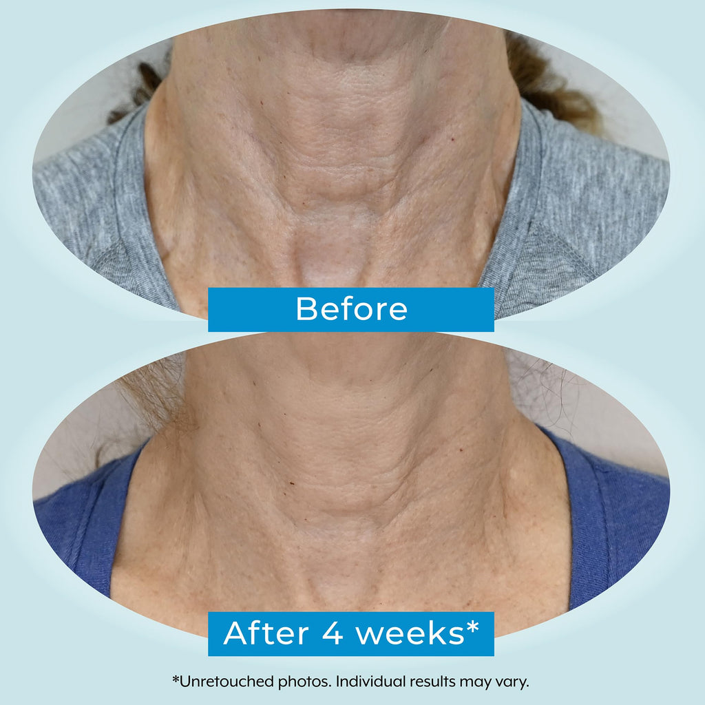 Plexaderm Dual Action Repair Neck Cream — 1 oz with Retinol, Bakuchiol & Hyaluronic Acid