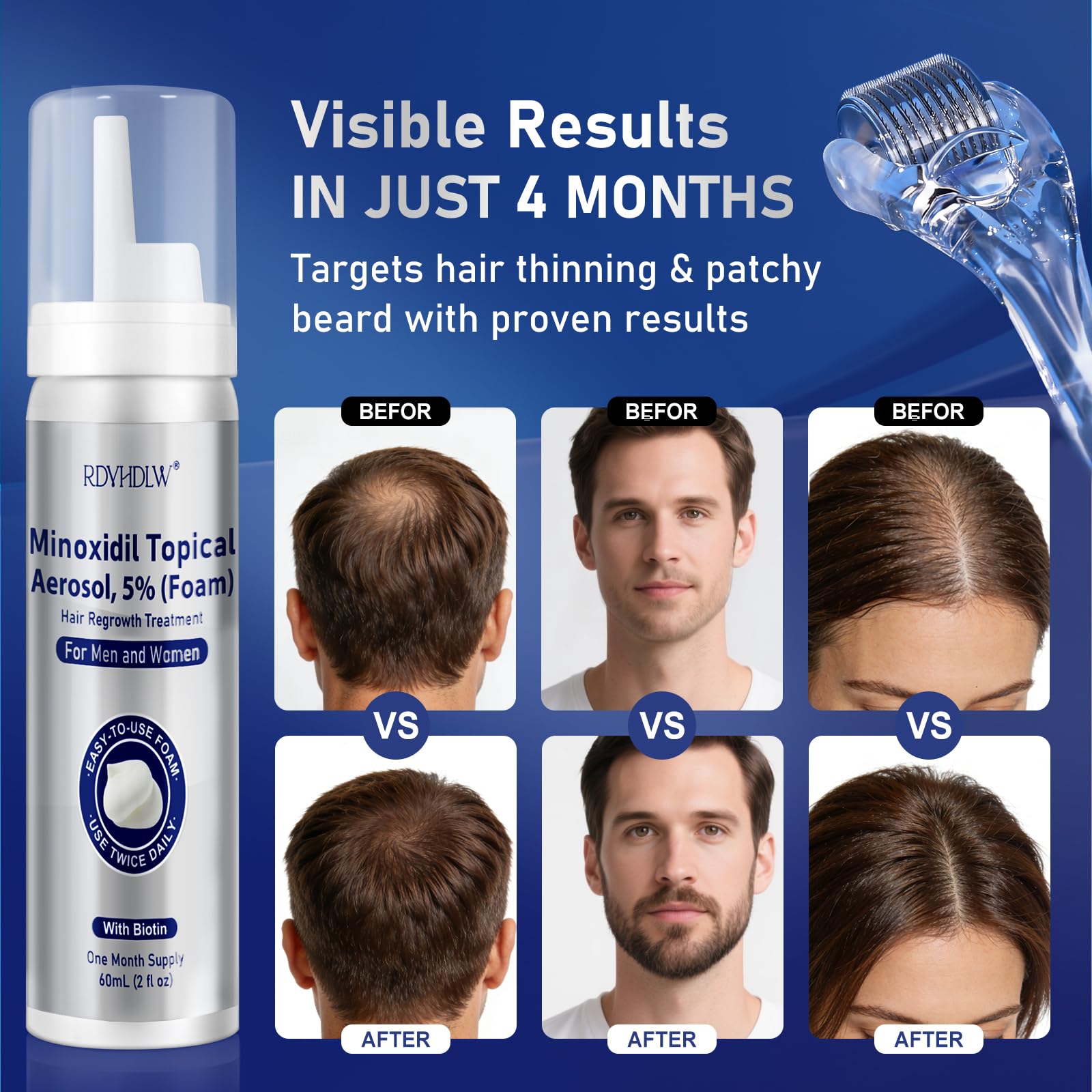 RDVHDLW 5% Minoxidil Foam for Hair Growth – Men & Women, 7-Month Supply (7x60ml)