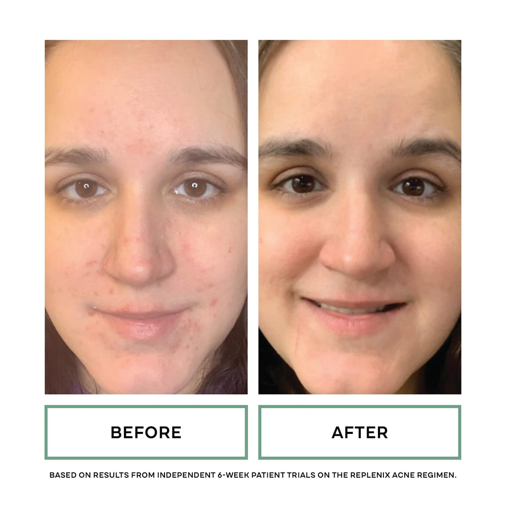 Replenix 10% Benzoyl Peroxide Acne Face Wash with Aloe | Clarifying Cleanser for Face & Body, 6.7 Fl Oz