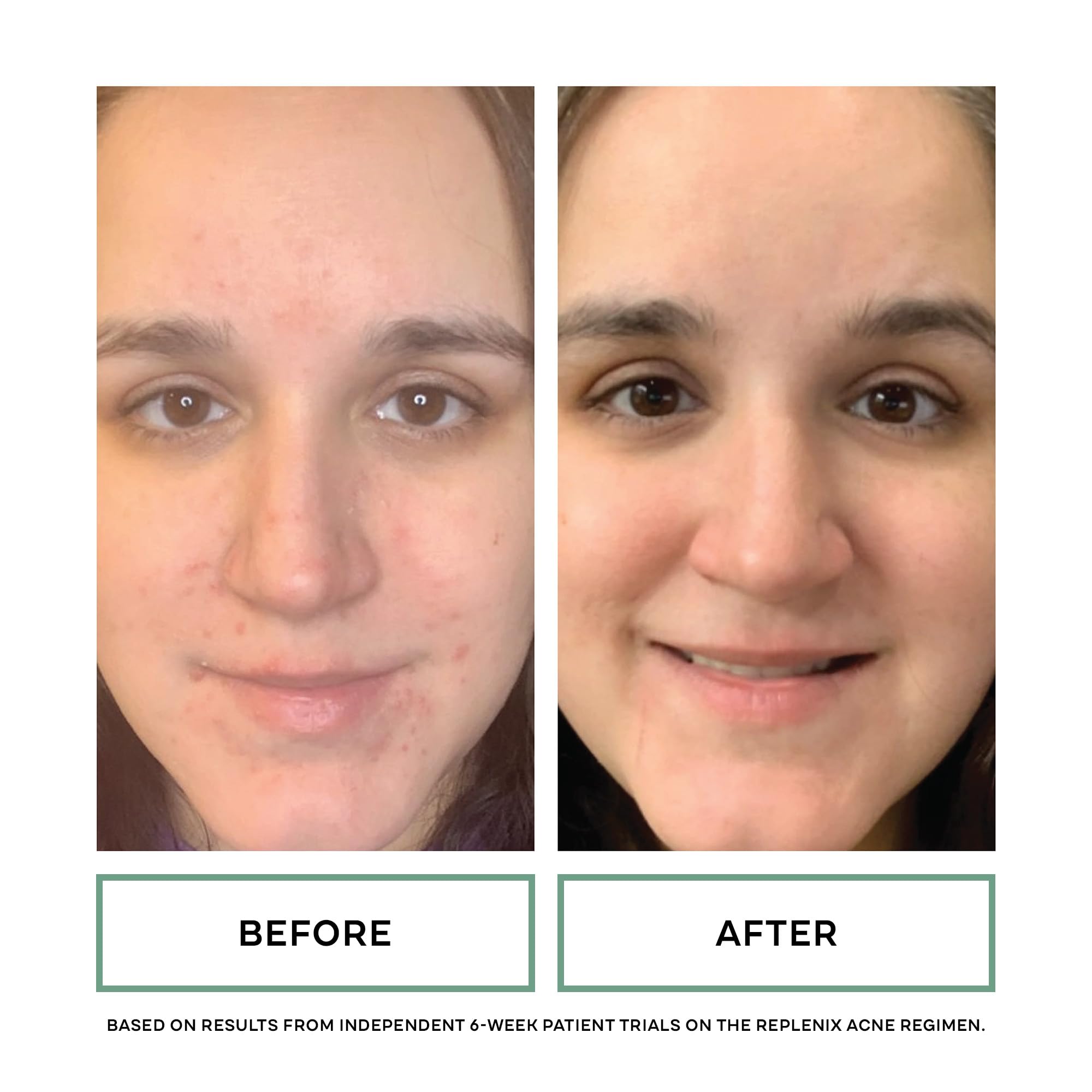 Replenix Benzoyl Peroxide 10% Spot Treatment – Acne Gel for Targeted Blemish Care