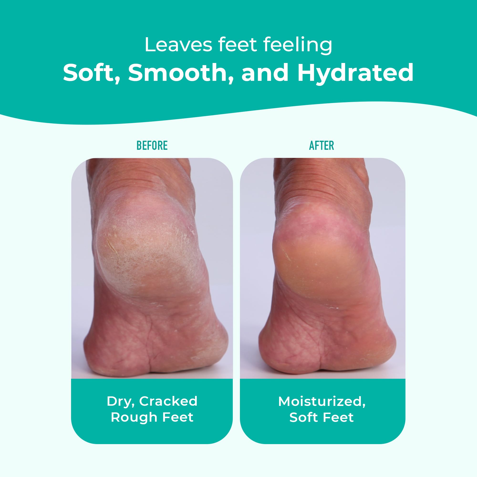 Richenna EZ Foot Care Cream – Advanced Exfoliating Urea Foot Cream for Dry Cracked Heels | 14 Natural Ingredients | 100ml
