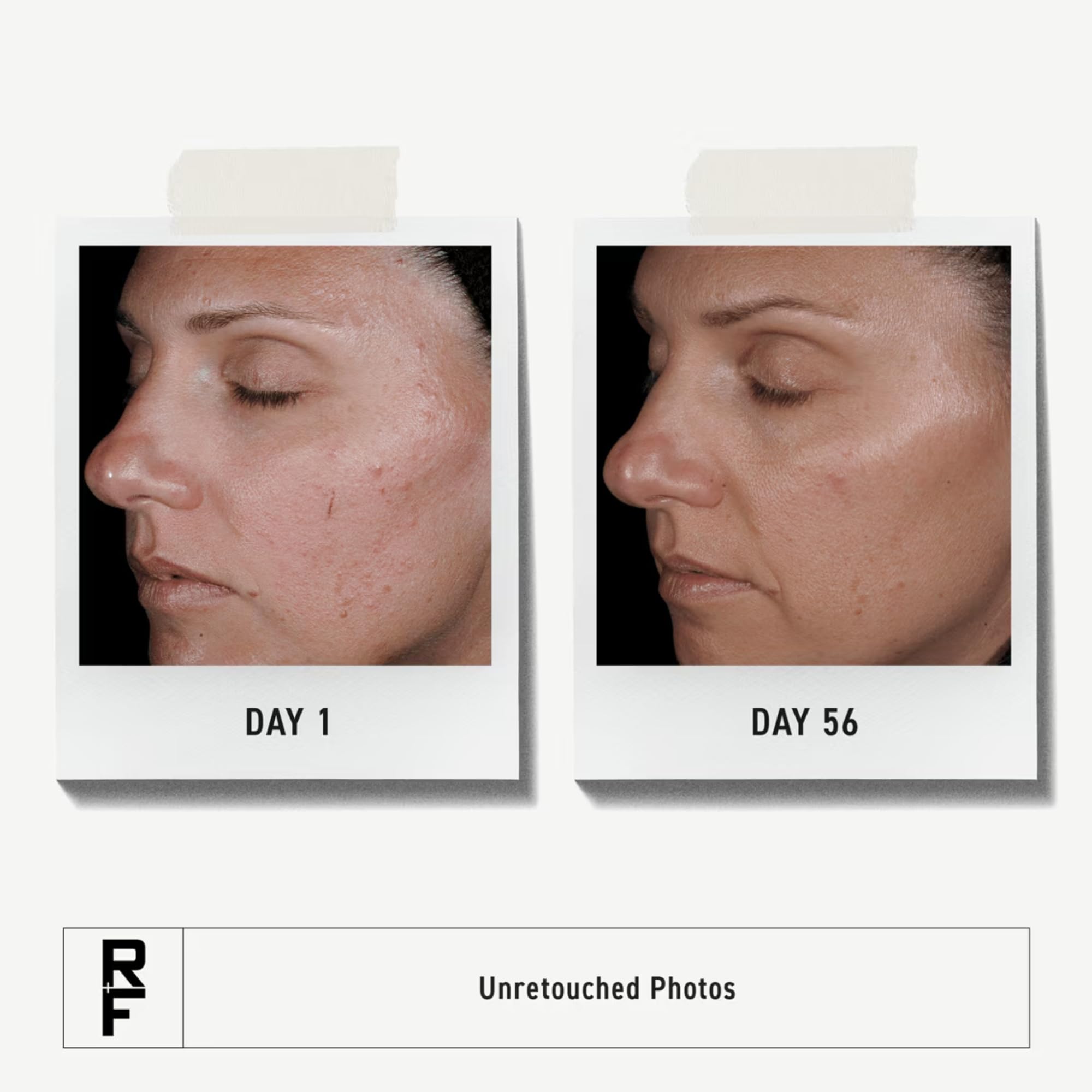 Rodan + Fields Unblemish Regimen – Acne Care Set with Cleanser, Toner, Treatment & SPF 30