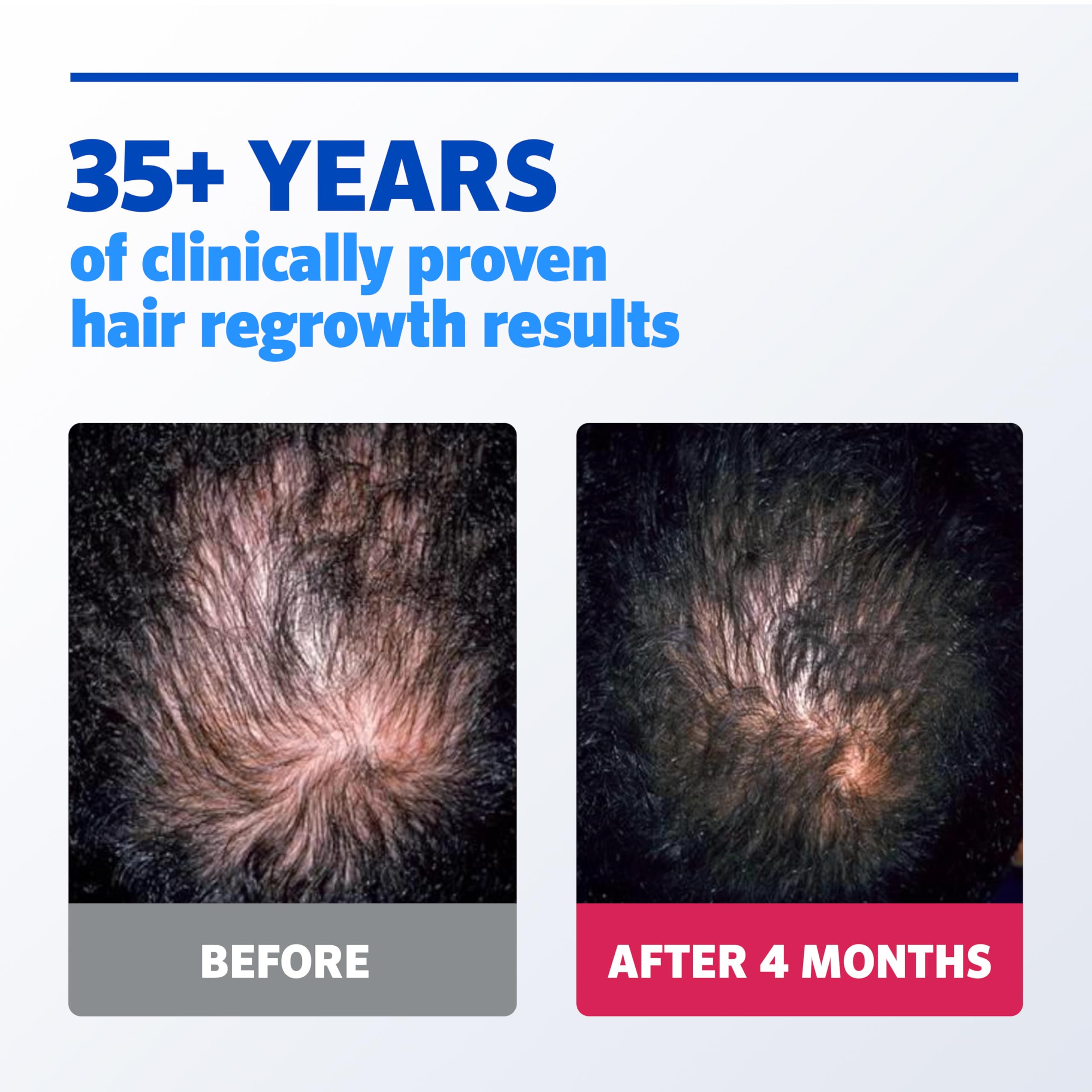 Rogaine Men’s Extra Strength 5% Minoxidil – Hair Regrowth for Men | 3-Month Supply