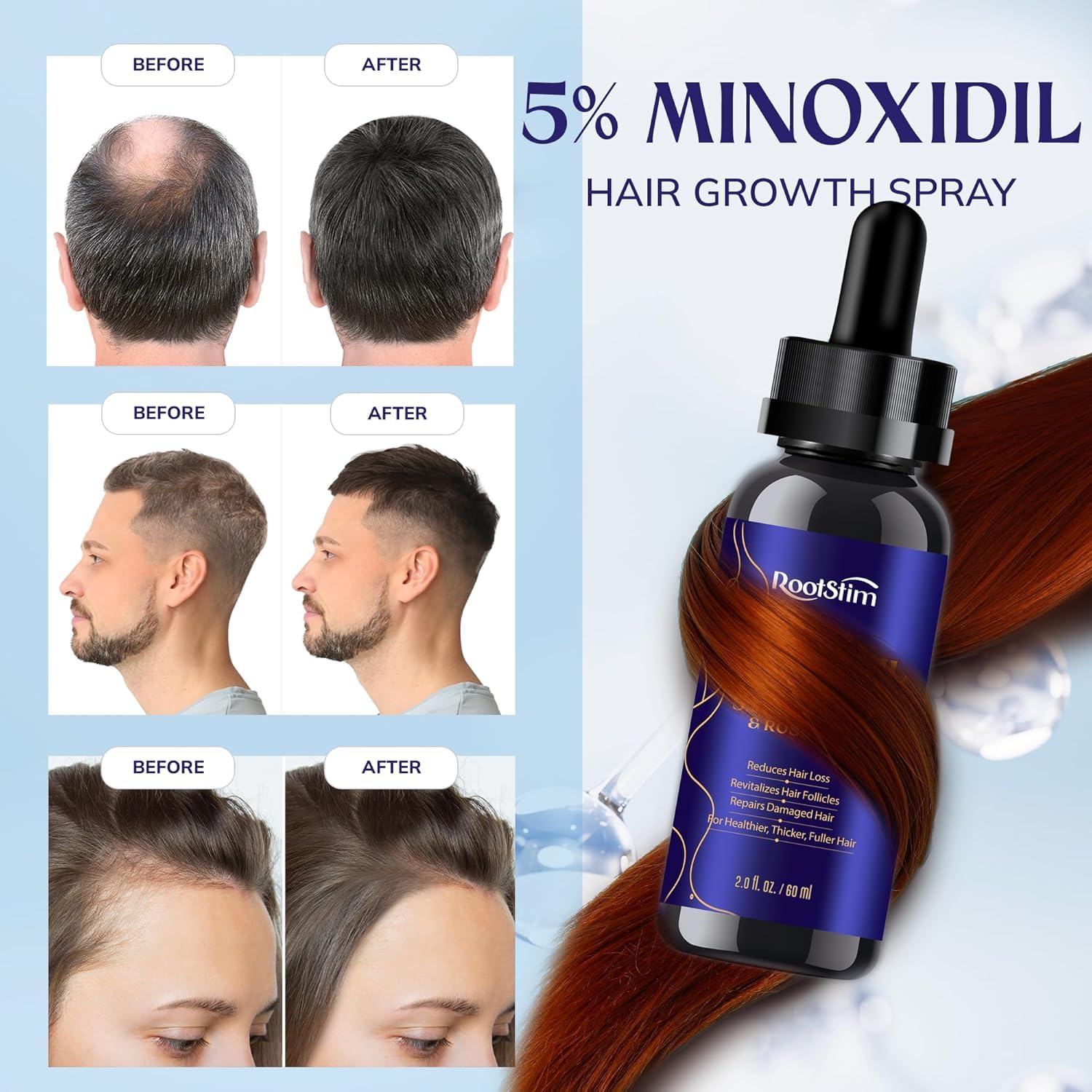 RootStim 5% Minoxidil Hair Growth Kit for Women — Fuller Hair with Biotin, Rosemary & Peptides, 2.03 fl oz