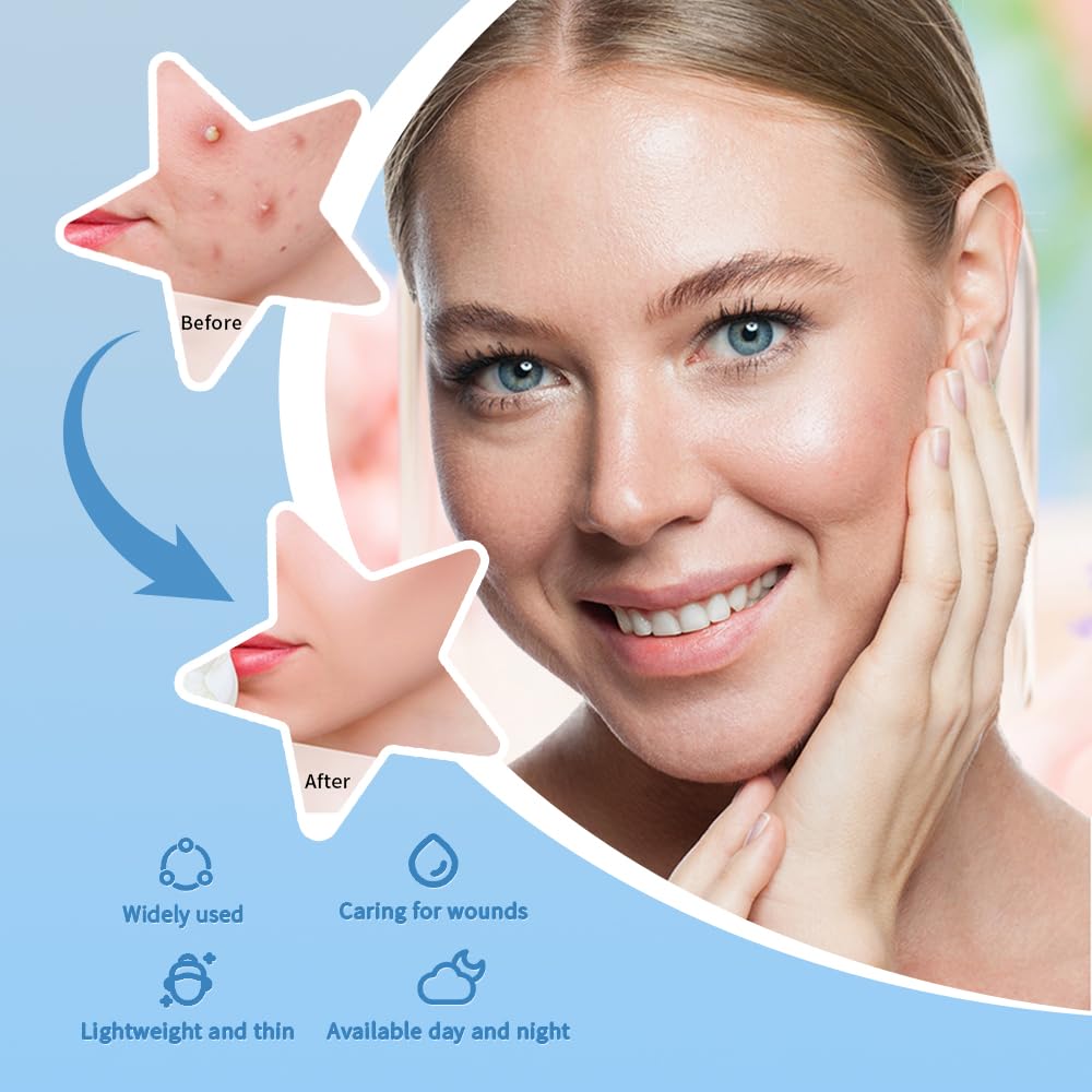 Safirst Star Acne Patches – Hydrocolloid Pimple Patches, 3 Sizes, 200 Count