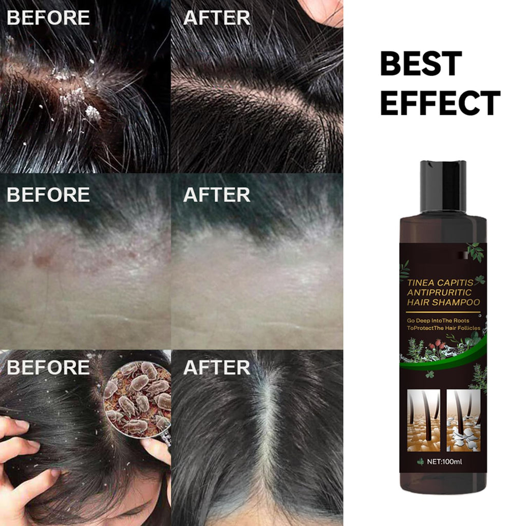 Scalp Flakes Antipruritic Shampoo – Natural Dandruff Care, Scalp Relief, 100ml