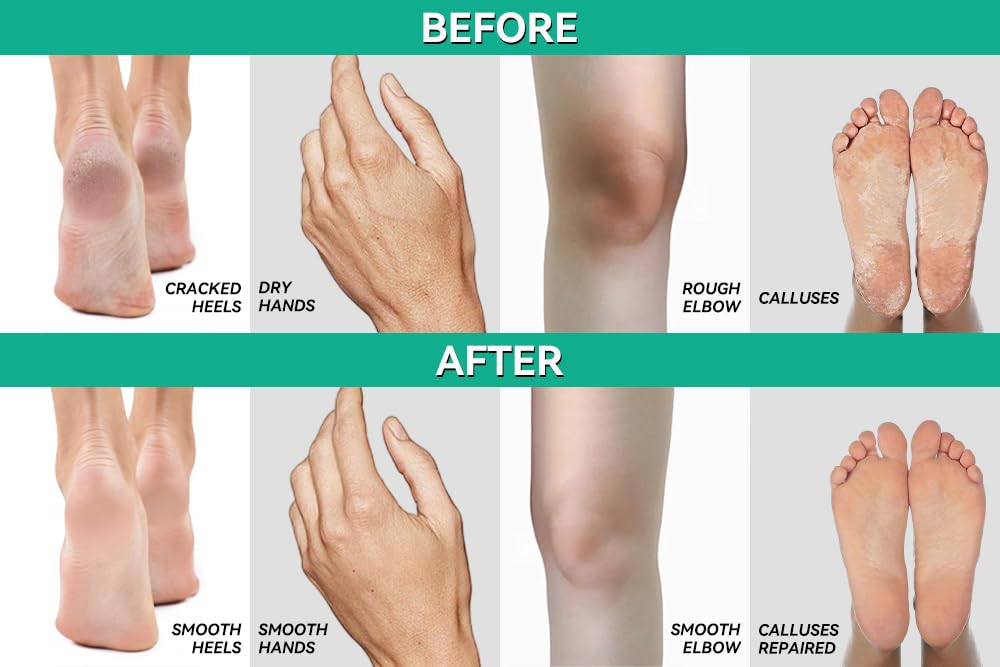 CLEAR 40% Urea Gel 4 oz with Tea Tree & Coconut Oil – Deep Hydration for Calluses, Cracked Heels, and Dry Skin | Scientific Solutions Global