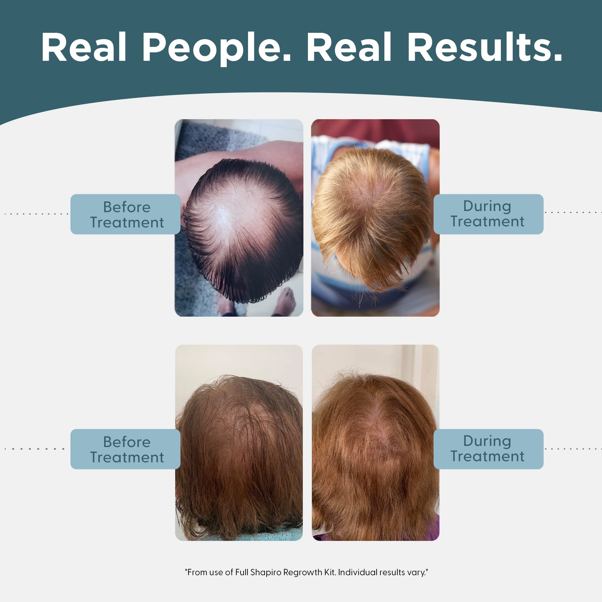 Shapiro MD Hair Growth Experts Mens Regrowth Travel Kit: 5% Minoxidil Leave-In Foamer for Thicker, Fuller Hair (1 Month)