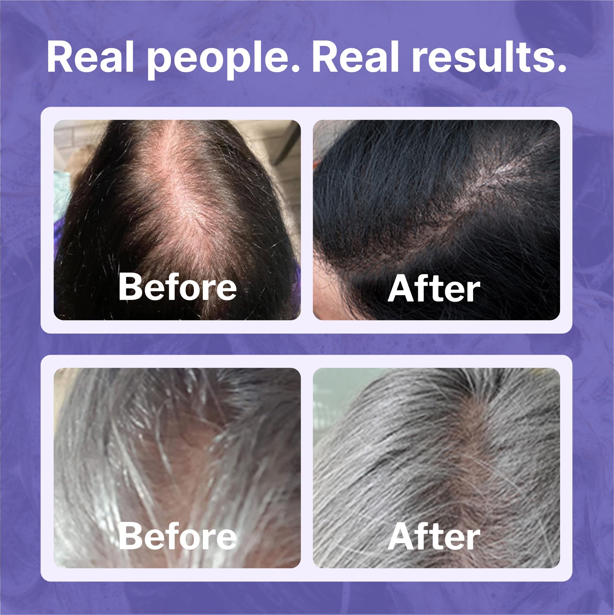 Shapiro MD Minoxidil 2% for Women – Hair Growth Serum by Shapiro MD Hair Growth Experts