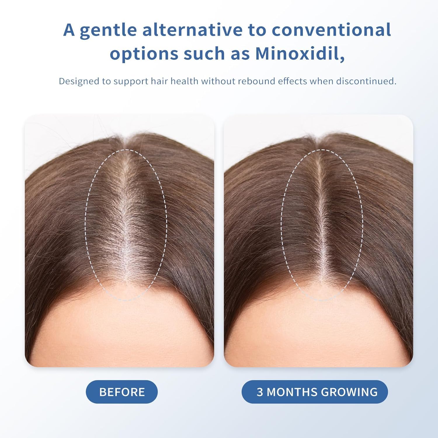 Hair Growth Serum for Thinning Hair | Singrace Biotin Roll-On – Fast Absorbing, No Rinse (30ml)