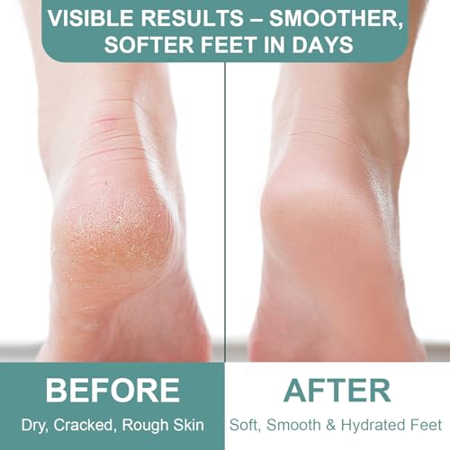 60% Urea Foot Cream with 2% Salicylic Acid – Overnight Heel Repair