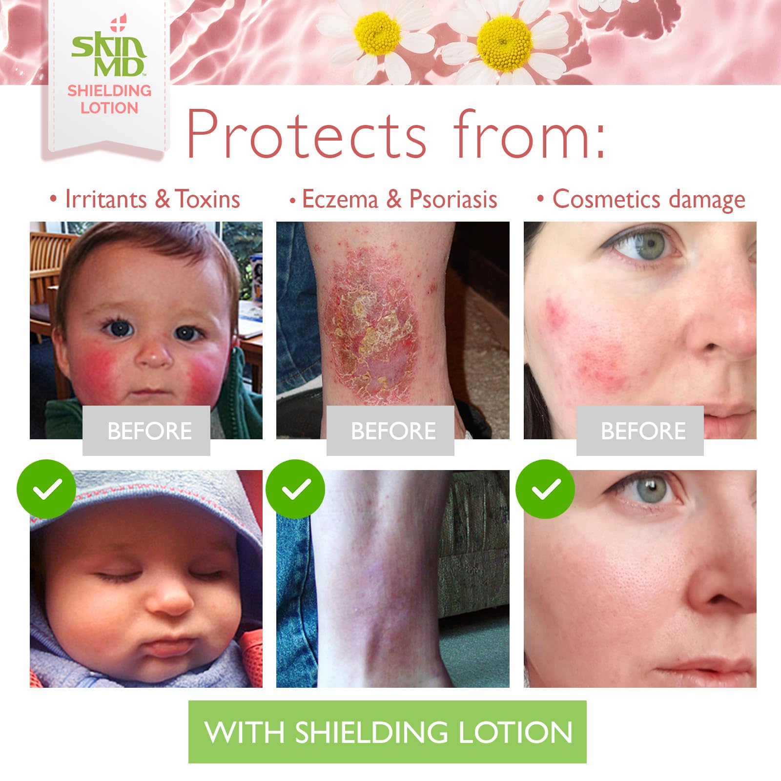 Skin MD Shielding for Face & Body | Hypoallergenic Moisturizer (8 oz)