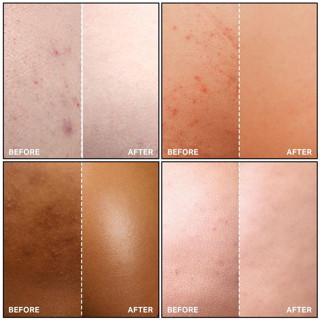 SKINBOSS Butt Acne Clearing Treatment – Hydrating Body Lotion for Back, Bum & Thighs (5 oz)