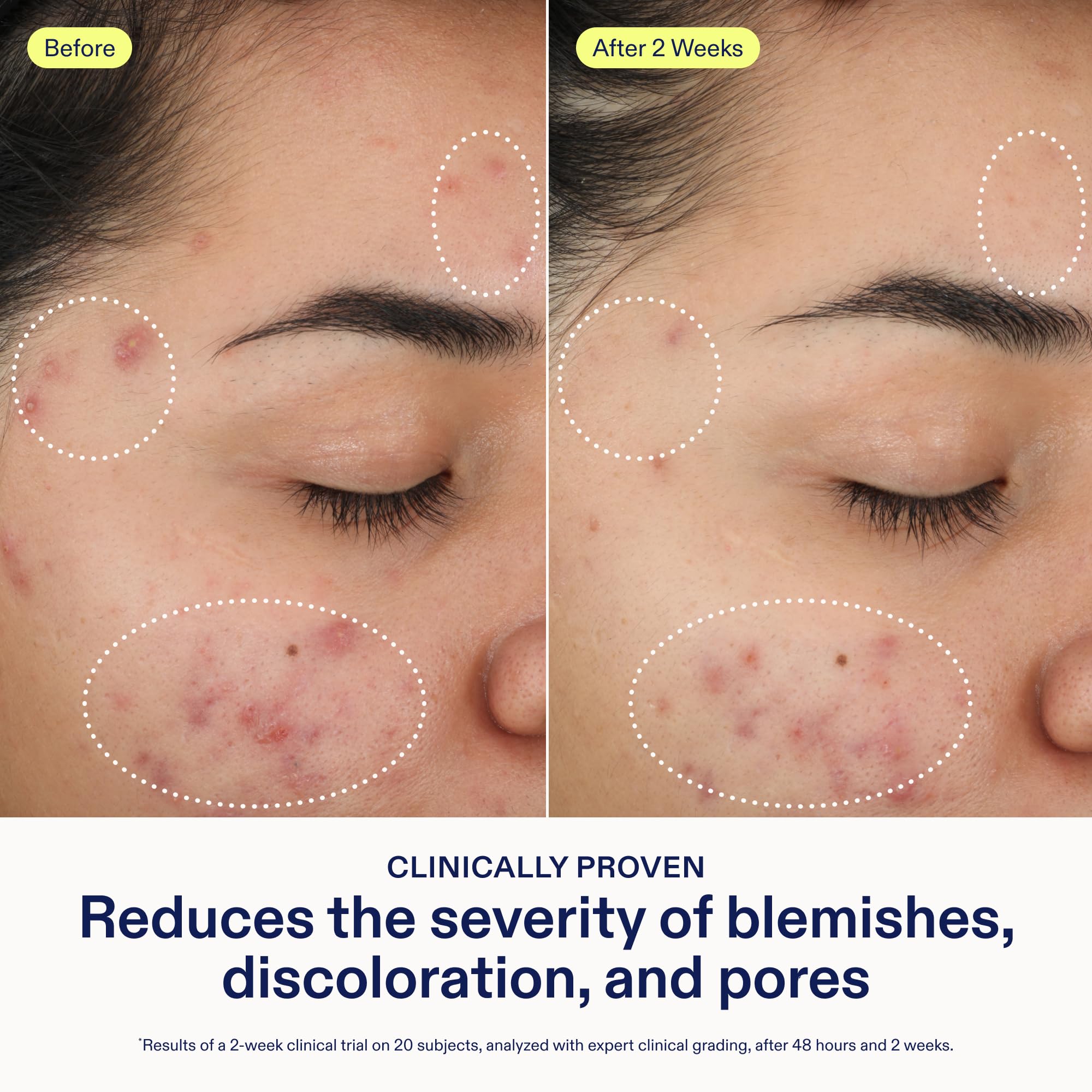 Skinfix 2% BHA Cleanser - Fragrance-Free Acne Care for All Skin Types (5 oz) | Vegan & Cruelty-Free
