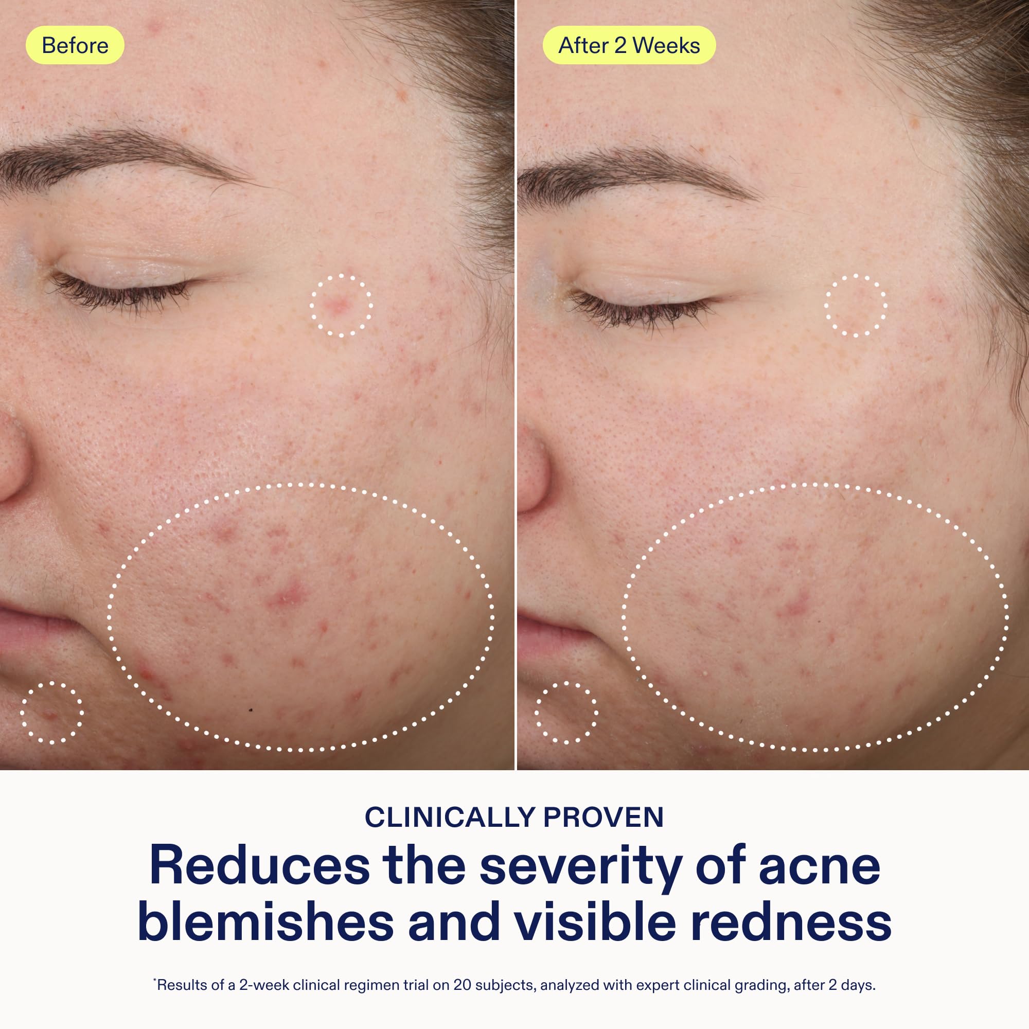 Skinfix 2% BHA Spot Treatment with Niacinamide – Fragrance-Free Acne Care (0.5 fl oz)