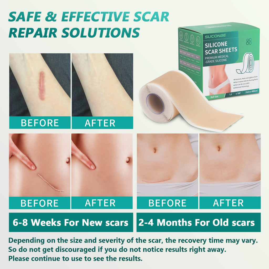 SUCONBE Silicone Scar Tape – Medical Grade Scar Sheets (1.6 x 160 in Roll) for C-Section, Tummy Tuck, and Post-Surgery Scars