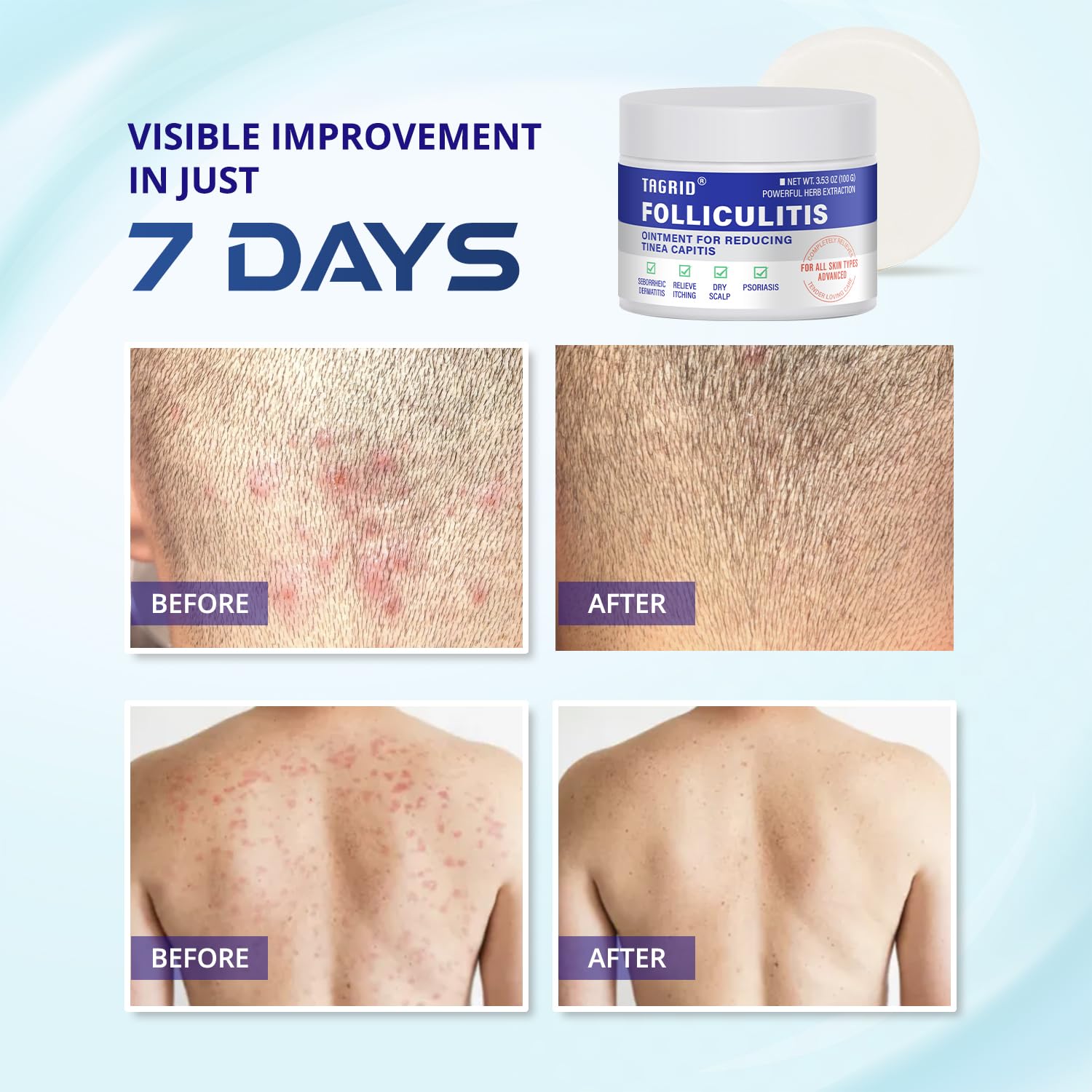 TAGRID Folliculitis Cream – Soothing Ingrown Hair & Hydration (100g)