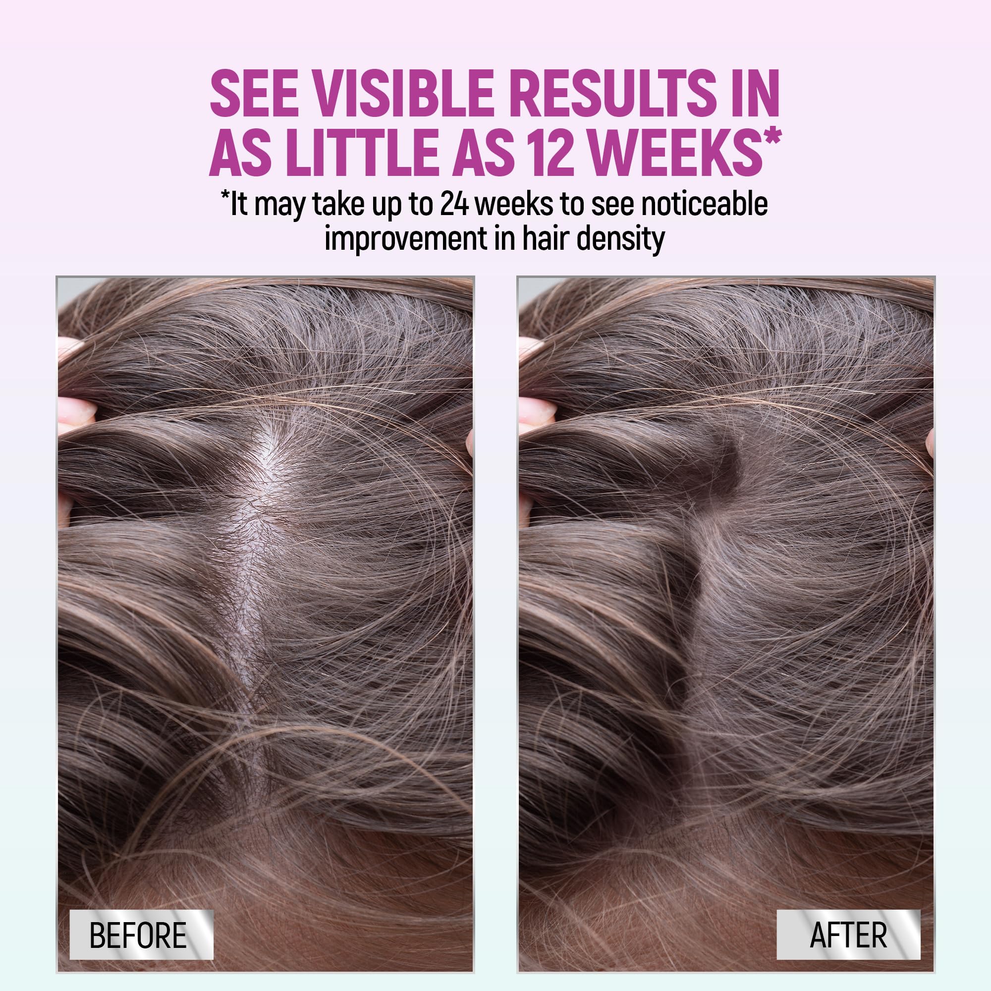 TARO Minoxidil for Women 5% Foam – 2.11 Oz (2 Months) Hair Regrowth Treatment