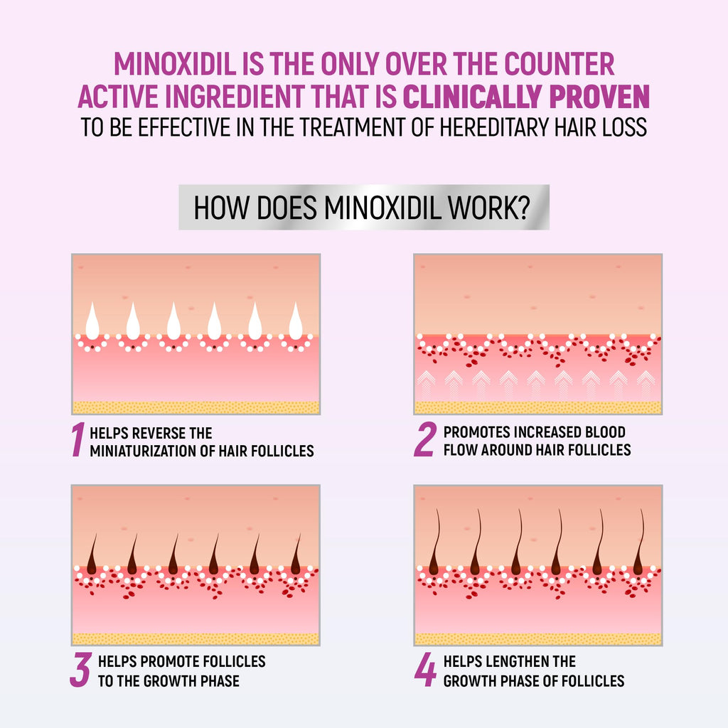 TARO Minoxidil for Women 5% Foam – 2.11 Oz (2 Months) Hair Regrowth Treatment