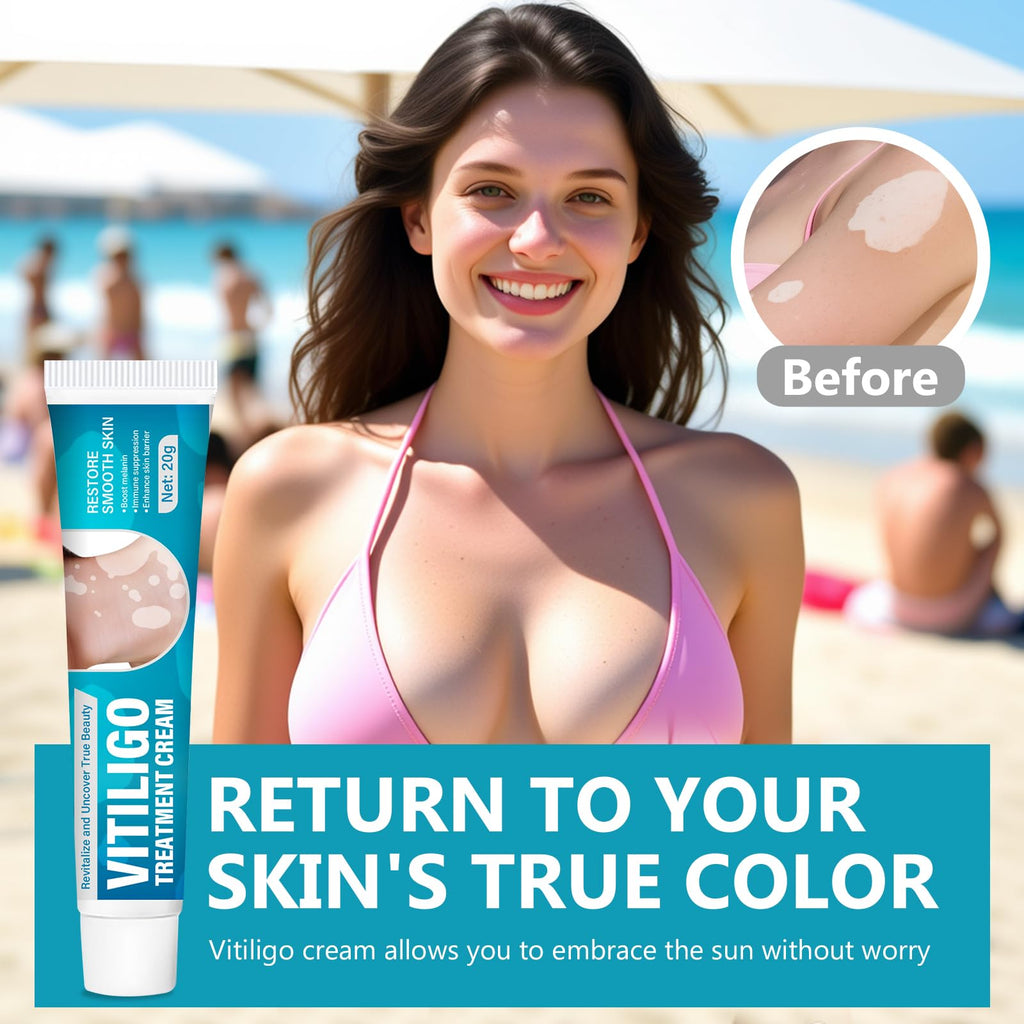 TDZLDM Vitiligo Cream - Natural White Spot Treatment for Face and Body